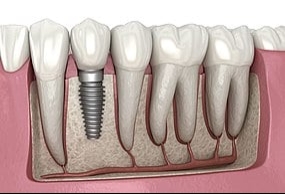 As superfícies do implante dentário desempenham um papel importante na fixação de tecidos, afastando bactérias indesejadas