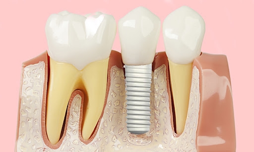 Investigação: Implantes dentários “inteligentes”
