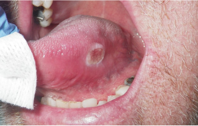 Razões para que os profissionais de medicina dentária se preocupem com o cancro oral