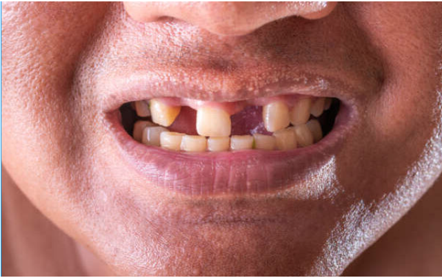 A perda de dentes pode afetar a capacidade funcional nos idosos