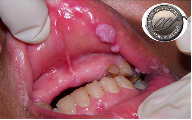 Lidar com as complicações do cancro oral e do tratamento - Conclusões do Congresso Mundial de Medicina Dentária (WDC) 2019.