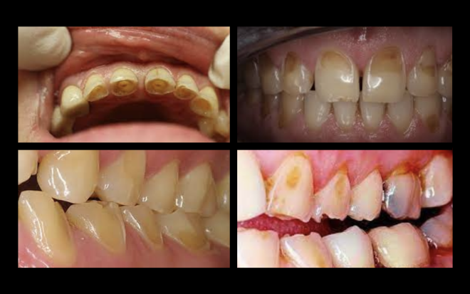 Nova técnica ajuda investigadores a entender como o ácido danifica os dentes