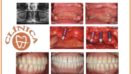 Caso Clínico - Dr. Eduardo Anitua DDS, MD, PhD