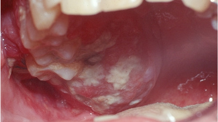 Prevenção do Cancro Oral: Um importante recurso de aprendizagem gratuita