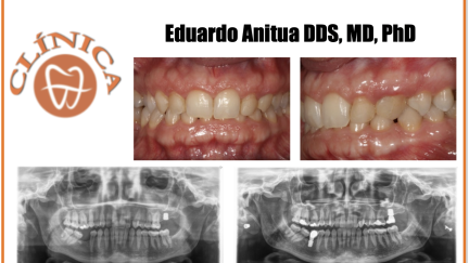 Implante curto unitário (5,5 e 6,5 mm) no segundo molar superior com elevação do seio transcrestal e enxerto autólogo obtido com o preparo alveolar. série de casos com análise retrospectiva.