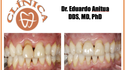 Caso clínico Dr. Eduardo Anitua DDS, MD, PhD