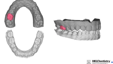 Próteses dentárias monomolares projetadas por IA