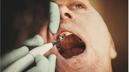 As infeção dentária silenciosa pode estar a prejudicar todo o seu corpo.