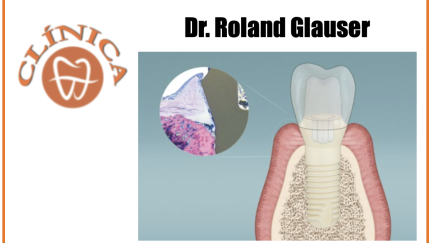 Peri-Implantite: Evitável com um novo conceito de implante