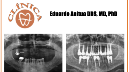 Reabilitação com implantes num paciente jovem com periodontite agressiva, perda dentária avançada e reabsorção óssea. Caso clínico com 23 anos de acompanhamento