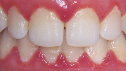 Níveis mais altos de citocinas na saliva correspondem a maior inflamação da gengiva