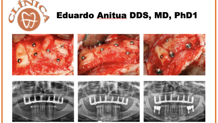 Caso clínico -  Dr.Eduardo Anitua
