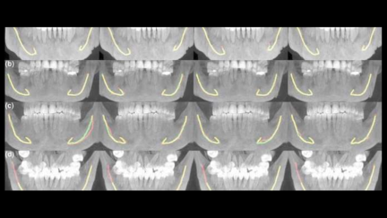 Inteligência artificial auxilia no atendimento odontológico e cirurgia da mandíbula