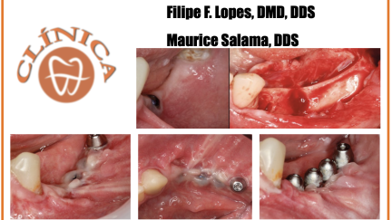 Caso Clínico: Dr. Filipe F. Lopes, DMD, DDS. e Dr.  Maurice Salama, DDS
