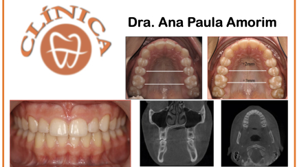 Eficácia clínica do tratamento com alinhadores