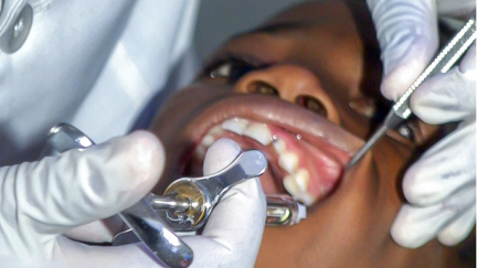 Programa dentário escolar em  N.York previne 80% das cáries com tratamento único e não invasivo