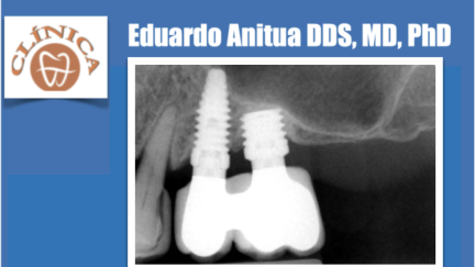 Caso clínico — Dr. Eduardo Anitua DDS, MD, PhD