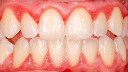 Novo teste caseiro para gengivite protege a saúde oral