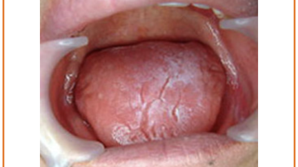Remédios naturais para  boca seca (Xerostomia)