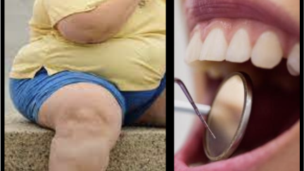 Estudo mostra que a saúde oral piora antes e depois da cirurgia bariátrica,