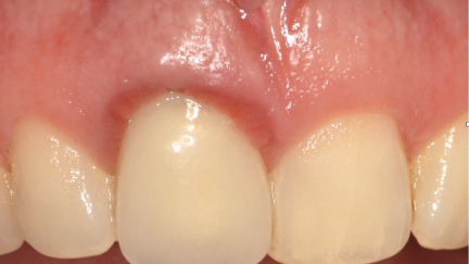 As gengivas macias tem maior tendência para inflamações