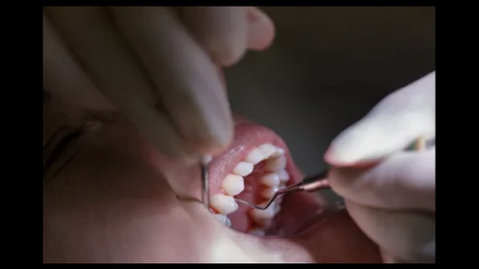 Pesquisa descobre maior risco de cárie dentária após cirurgia bariátrica