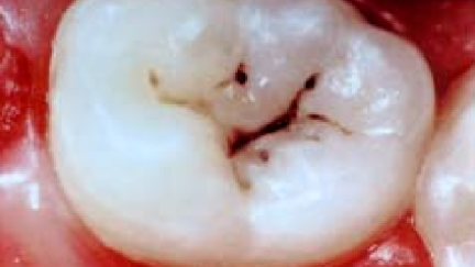 Estudo explora o uso de algoritmo de “deep learning” para detetar cárie oclusal