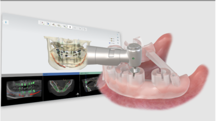 O OneGuide da Osstem Implant celebra o seu 10.º aniversário, reforçando a sua competitividade na medicina dentária digital