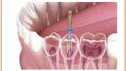 Biomaterial poderá vir a  manter o dente vivo após o tratamento de canal radicular