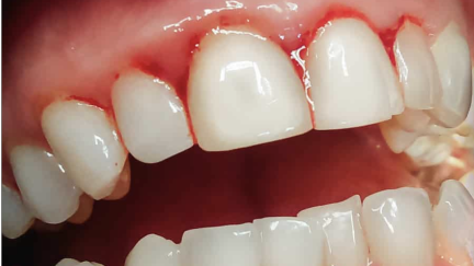 Investigação identifica tratamento potencial para gerir os efeitos da periodontite