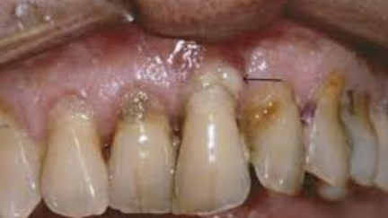 Cadeia alimentar microbiana: interações nutricionais que promovem a periodontite