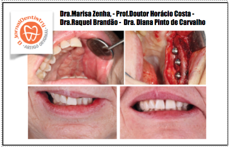Reabilitação sobre Implantes Pós-Maxilectomia - Caso Clínico
