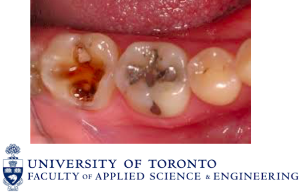 A luta contra a cárie dentária conta  com um novo material inteligente