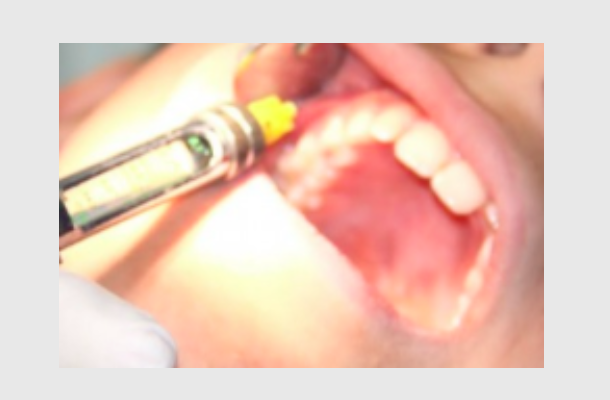 Pesquisa revela uma nova maneira de administrar anestésico na boca
