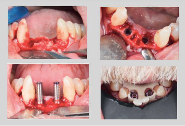 Planeamento em implantes