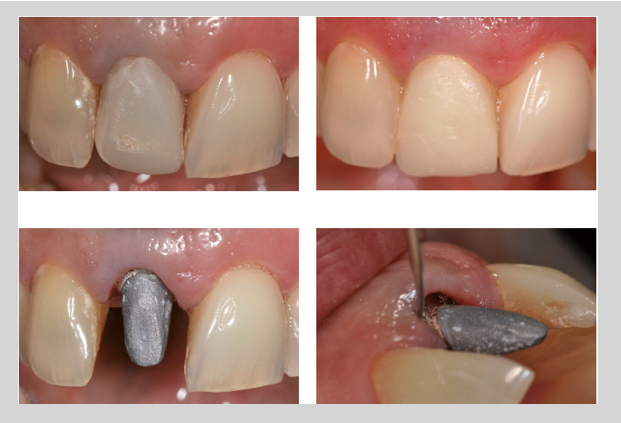 Cor dentária em reabilitações fixas anteriores