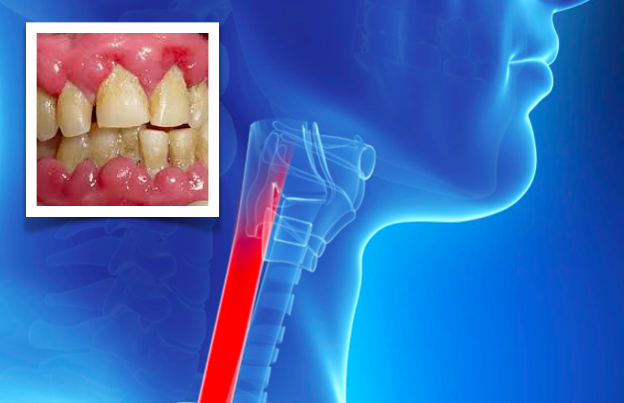 Doença periodontal ligada a aumento de risco de cancro em mulheres idosas