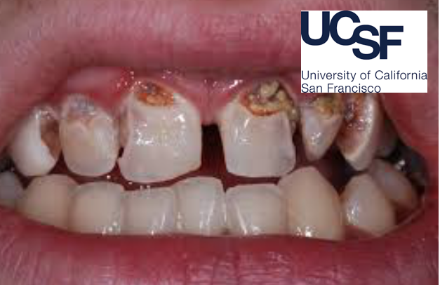 A redução efetiva das cáries dentária passa pela abordagem da prevenção