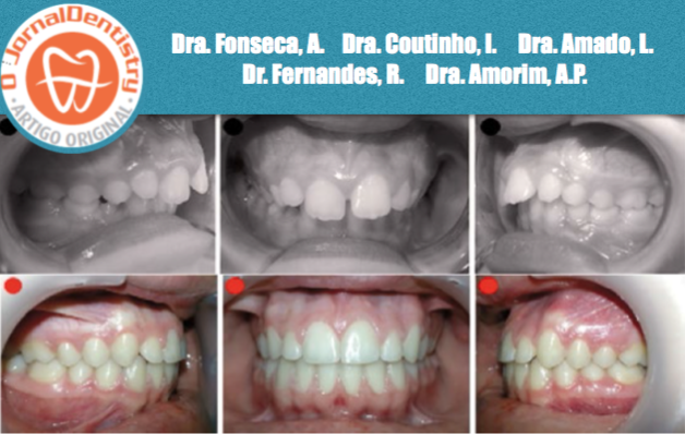 Tratamento de anomalia de Classe II Divisão 1 em 2 fases: Bionator + Aparelho Fixo