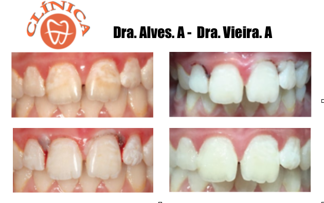 Infiltração com resina em dentes hipomineralizados a propósito de um caso clínico.
