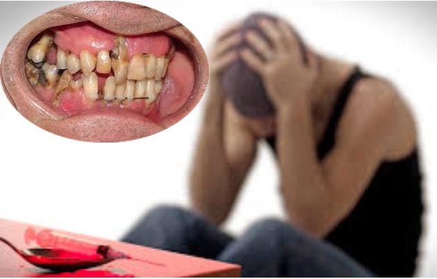 Confirmada a relação entre o consumo de drogas e a saúde oral