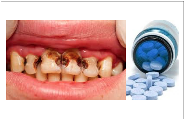 Estudo sobre o tratamento de cáries dentárias usado medicamento para a doença de Alzheimer