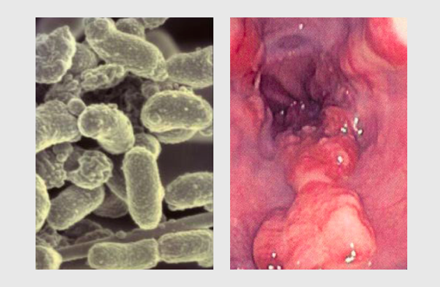 Investigadores descobriram associação entre bactérias orais e o cancro do esófago.