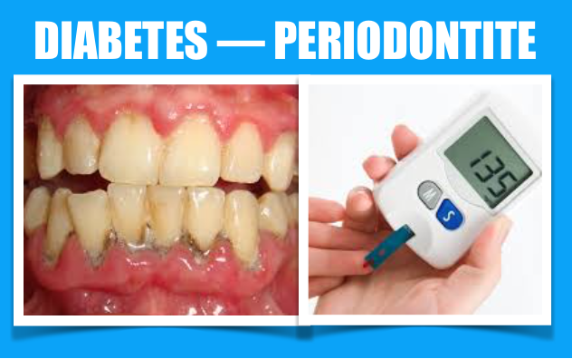 Estudo mostra que a diabetes provoca alterações no microbioma oral originando periodontite