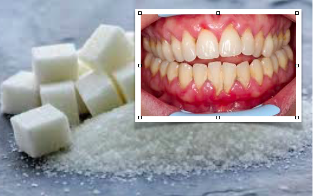 O alto consumo de açúcar dá origem a custos de tratamento dentário de milhares de milhões de euros mundialmente.