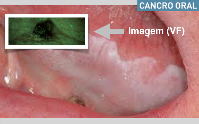 Visualização de Fluorescência (VF) para deteção do cancro oral em estágio inicial