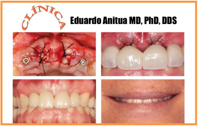 Caso clínico com 15 anos de acompanhamento — Dr.Eduardo Anitua MD, PhD, DDS