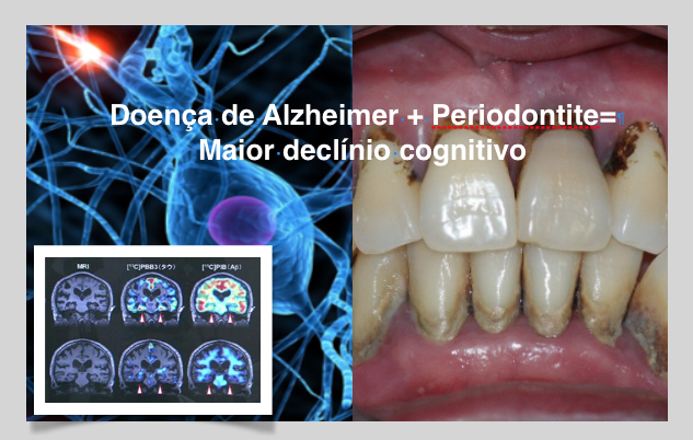 Investigação deteta ligações entre a doença da gengivas e o declínio cognitivo na doença de Alzheimer