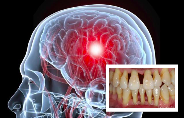 Adultos com doença periodontal com maior risco de Acidente Vascular Cerebral isquémico - Estudo