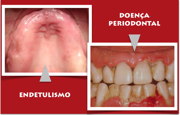 Estudo associa doença periodontal, perda de dentes e maior risco de morte